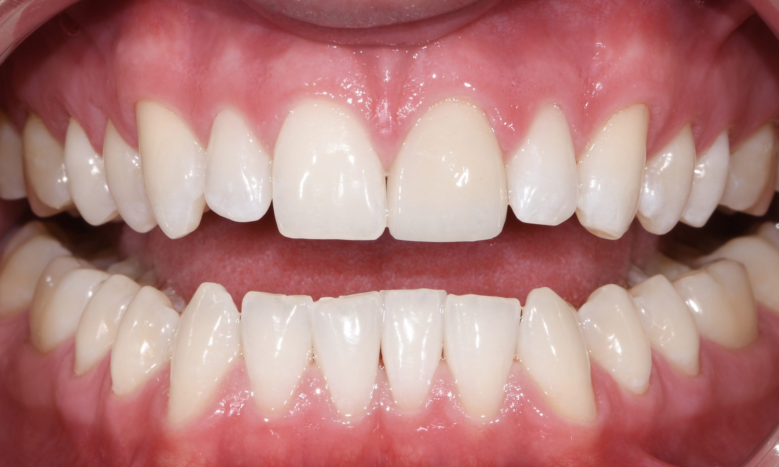 2 1 Ceramic Veneer Post Op 2 1 scaled