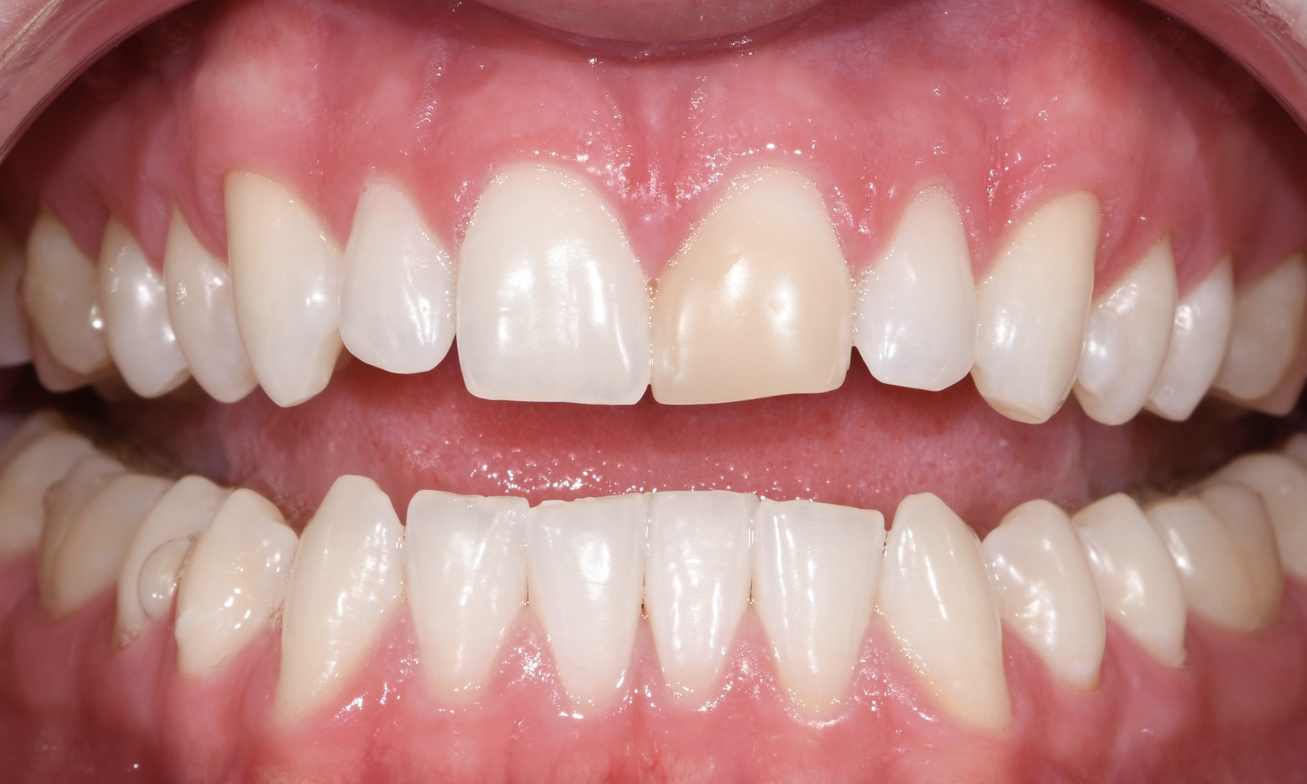 2 1Ceramic Veneer Pre Op 2 1 scaled