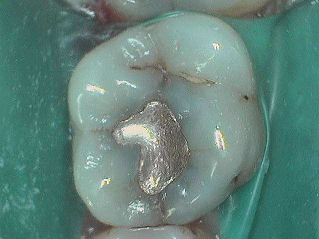 Amalgam Replacement 2.1