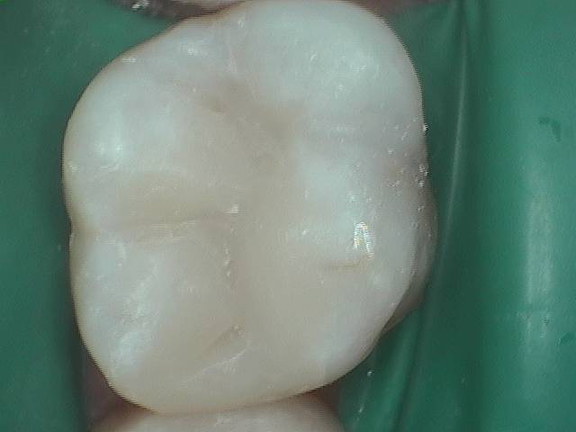 Amalgam Replacement 2.2