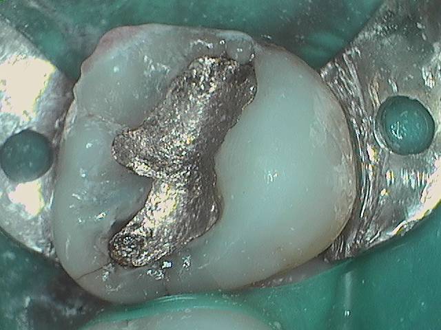 Amalgam Replacement 3.1