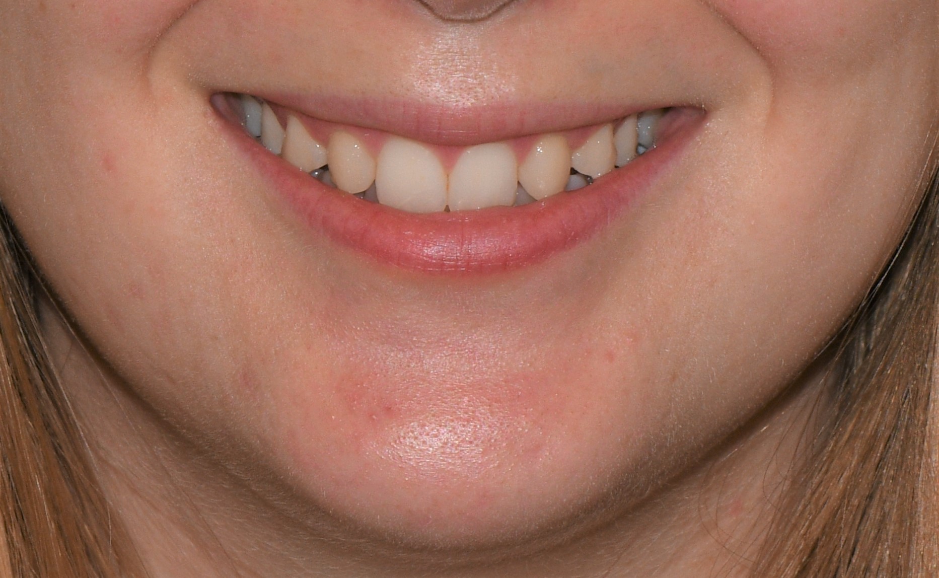 Botox Gummy Smile  After