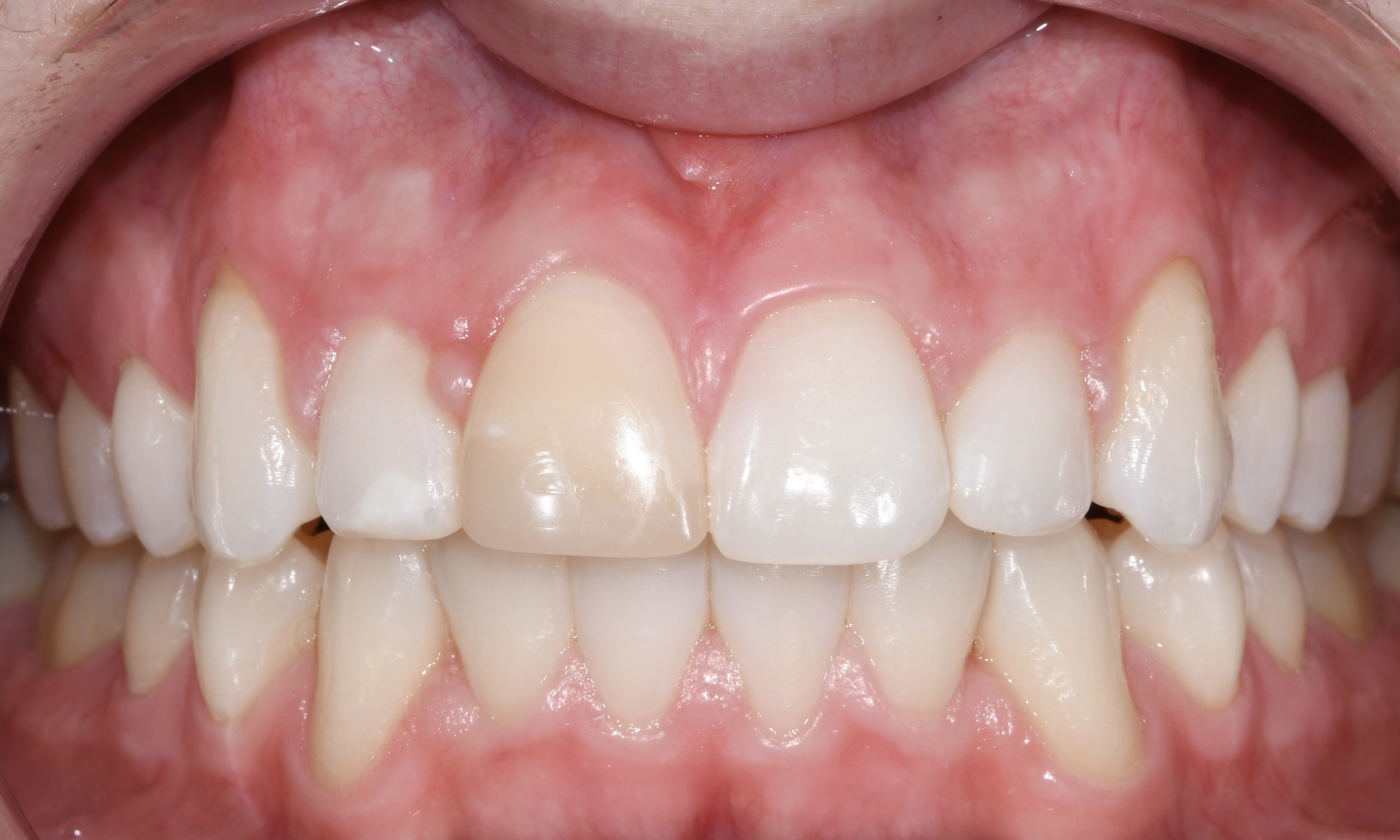 Ceramic Veneer Pre Op 1 scaled