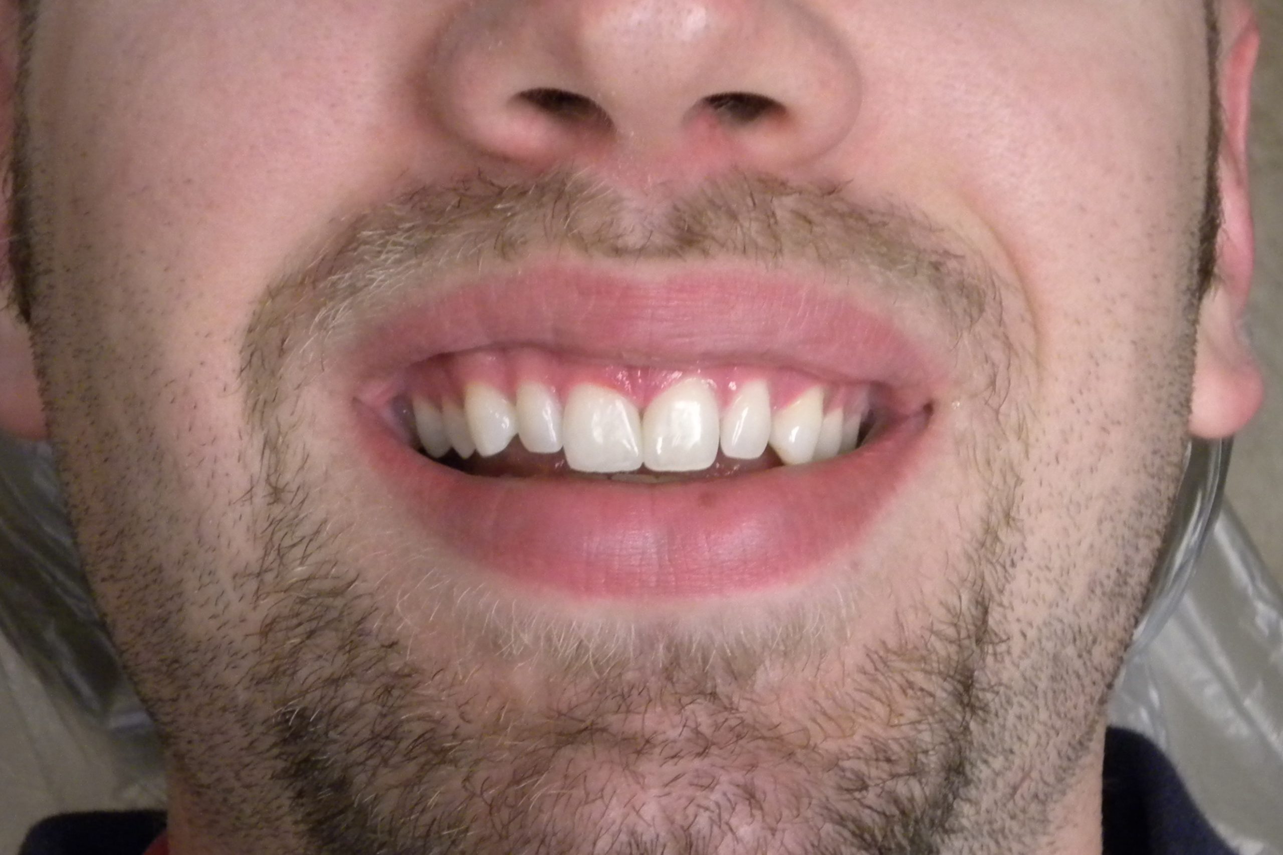 Composite Veneers Laterls Pre op scaled