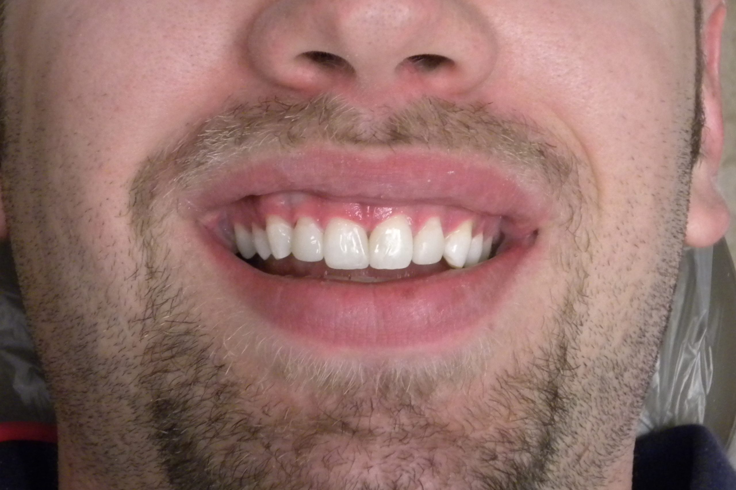 Composite Veneers Post op scaled