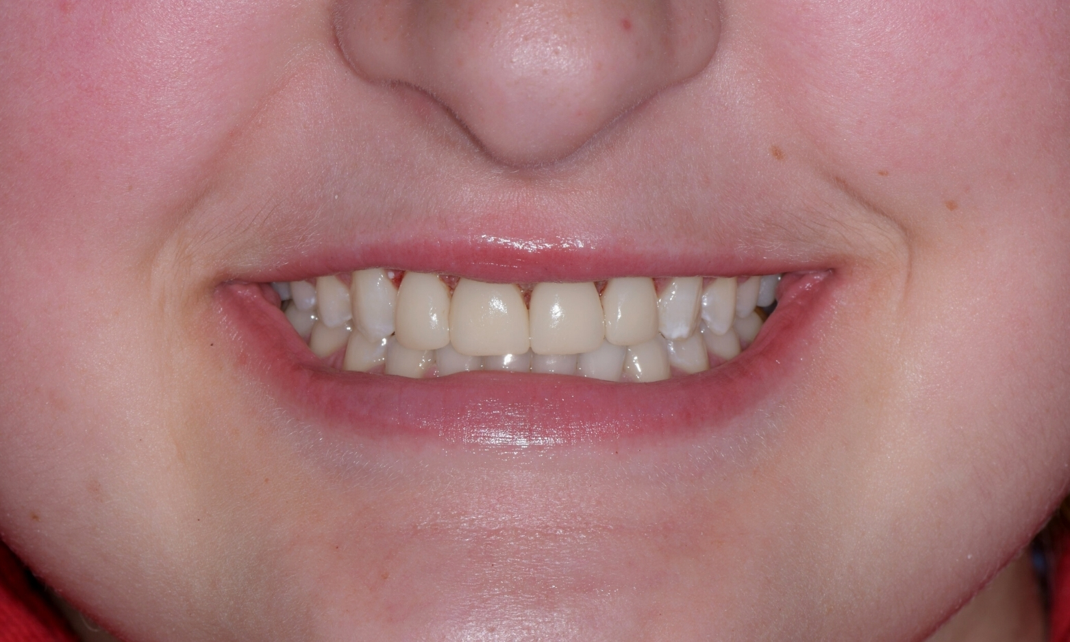 Eckland Family Dentistry Composite Bonding Case Study After