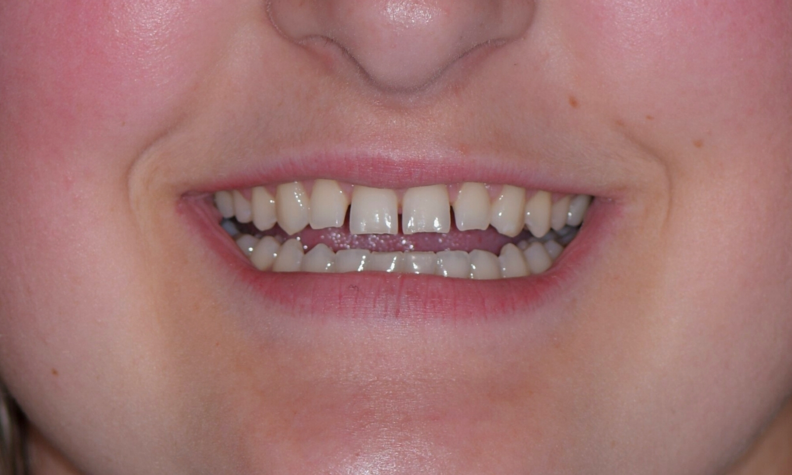 Eckland Family Dentistry - Composite Bonding Case Study - Before