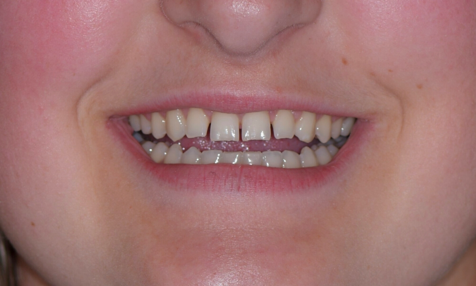 Eckland Family Dentistry Composite Bonding Case Study Before