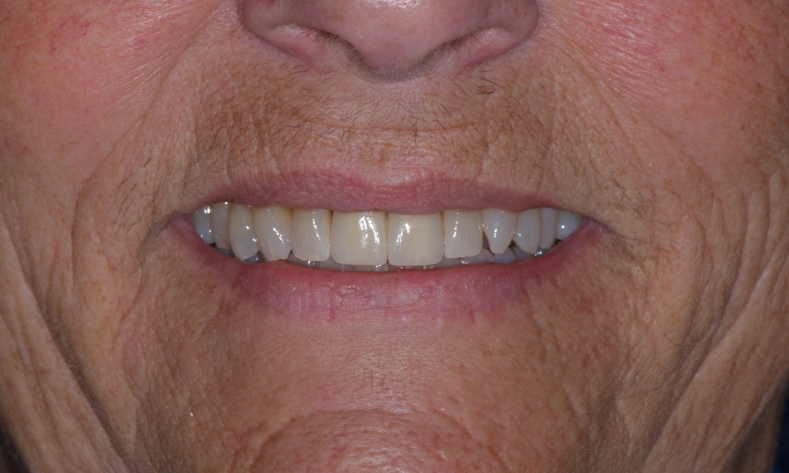 Eckland Family Dentistry - Dental Implants & Crowns - After - 1