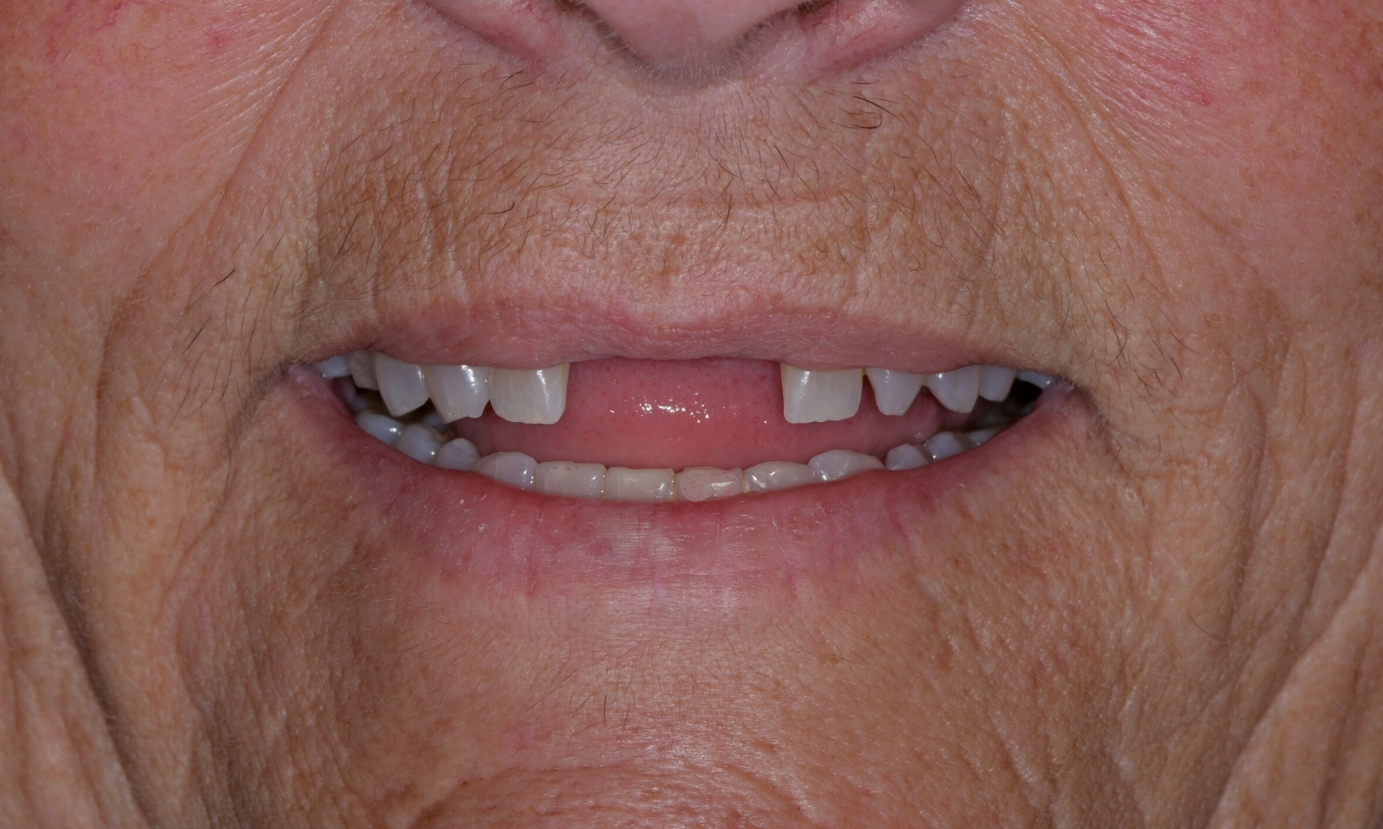 Eckland Family Dentistry Dental Implants Crowns Before