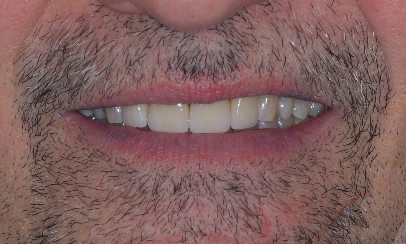 Eckland Family Dentistry Replacement of Dental Crowns After