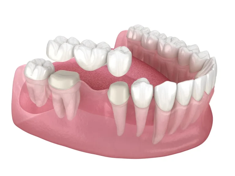 Dental bridge of 3 teeth over molar and premolar. Medically accurate 3D illustration of human teeth treatment