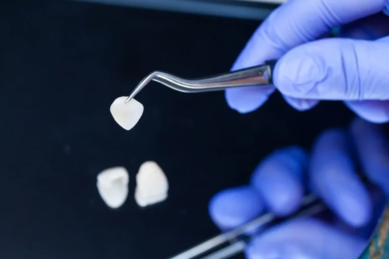 A dentist is holding tweezers for dental ceramic veneers and crowns.